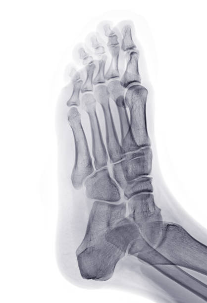 istock Foot x-ray image Oblique  view  isolated on White  background. 1489103816