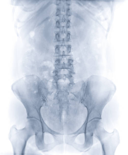Plain Abdomen or plain kub is x-ray image of human abdominal part. stock photo