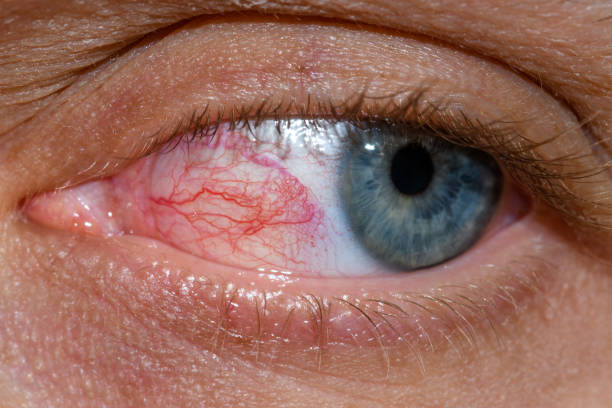 istock Close-up of a bloodshot eye 1489368464