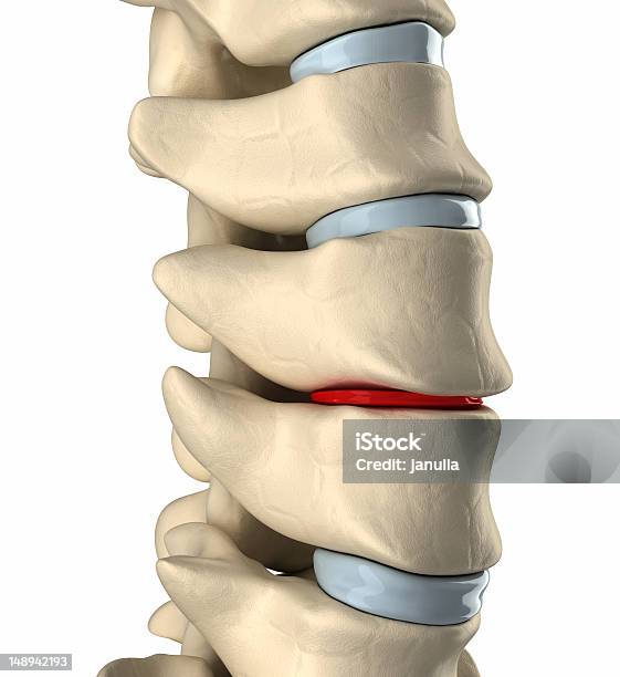 Thinning Disc Deformation Stock Photo - Download Image Now - Intervertebral Discs, Anatomy, Arthritis