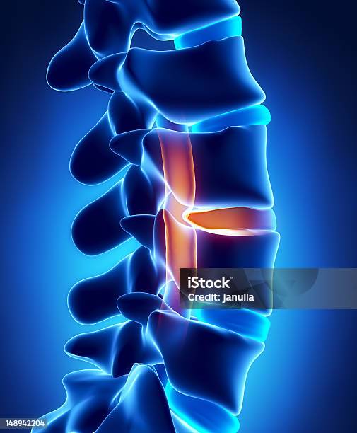 Herniated Disc With Pressure On Spinal Cord Stock Photo - Download Image Now - Blue, Human Vertebra, Anatomy