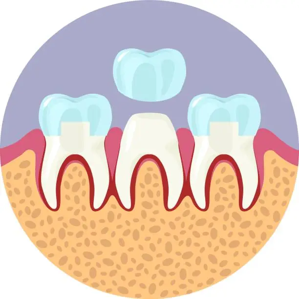 Vector illustration of Installation of dental crown vector tooth care icon