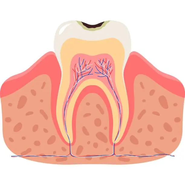 Vector illustration of Tooth affected by caries in gum vector icon isolated on white background