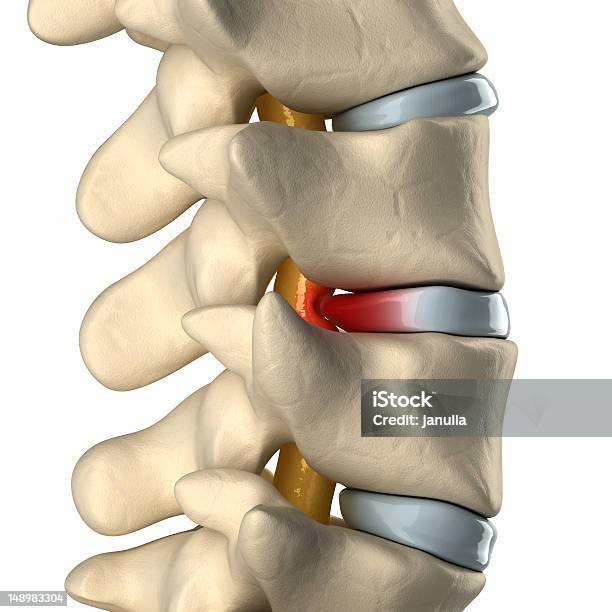Spinal Cord Under Pressure Of Bulging Disc Stock Photo - Download Image Now - Spine - Body Part, Physical Pressure, Deterioration