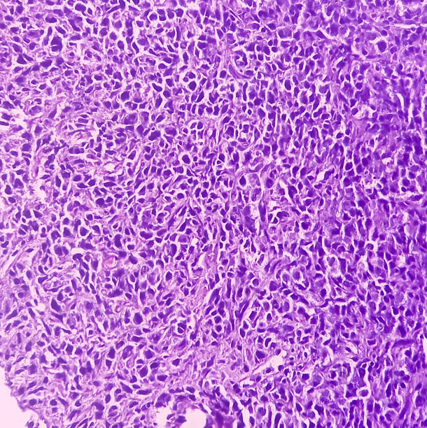 Sarcoma Example 120+ Soft Tissue Sarcoma Stock Photos, Pictures & Royalty-Free Images ...