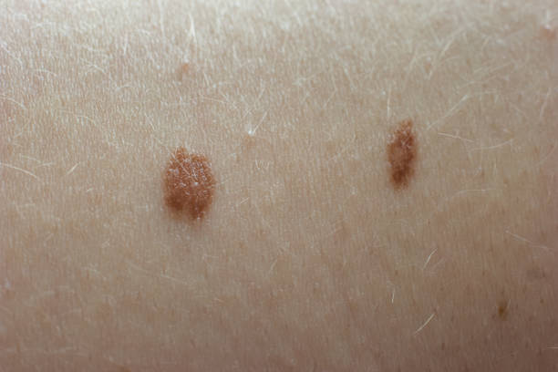 istock Young woman's skin birthmarks or moles. Close up macro shot, unrecognizable 1490271085