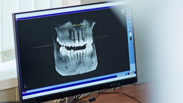 Dentist looking 3d model of x-ray of patient's jaw. 3d model of teeth on monitor