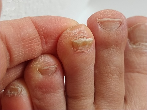 onychomycosis with fungal nail infection. Onychomycosis and dry skin. Candida fungus caused itching, cracks, redness, exfoliation of skin particles. Dermatological problem.