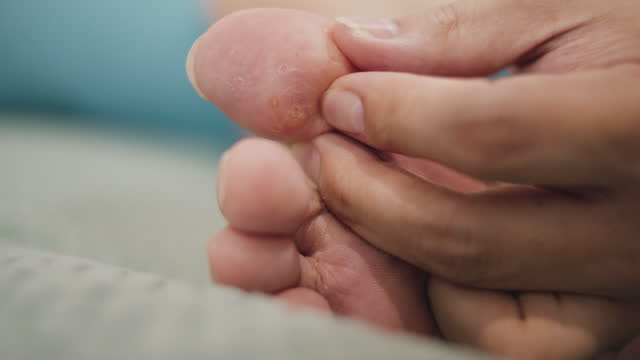Close-up of the skin allergy on foot finger
