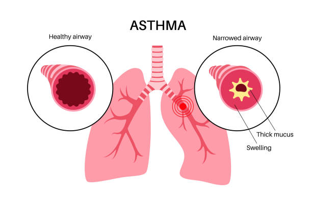 Asthma lung disease Asthma disease concept. Shortness of breath, chest tightness, causes of cough. Narrow and swell airways, extra mucus in lungs. Allergic condition, problem with respiratory system vector illustration asma stock illustrations