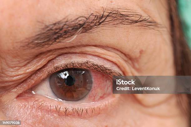 Photo libre de droit de Infectés Des Yeux banque d'images et plus d'images libres de droit de Yeux irrités - Yeux irrités, Glaucome, Macrophotographie