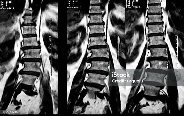 퇴행성 요추 척추 척추측만증 척추-신체 부분에 대한 스톡 사진 및 기타 이미지 - 척추-신체 부분, MRI 스캔, 척추측만증