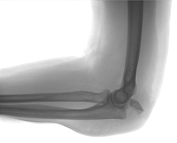 Elbow fracture stock photo