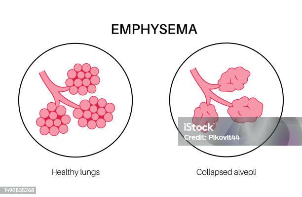 Empha Emphysema Anatomical Poster Stock Illustration - Download Image Now ...