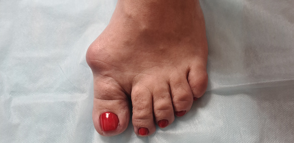 Problem foot with bunion and hallux valgus. Flat-valgus foot deformity treatment and help concept