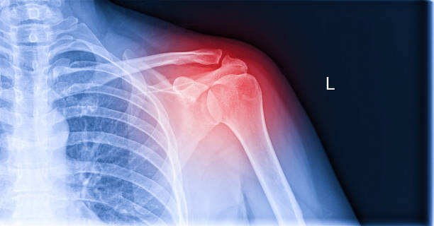 рентгеновское изображение боли в плече, тендинита связок плеча, растяжения мышц плеча - rotator cuff стоковые фото и изображения