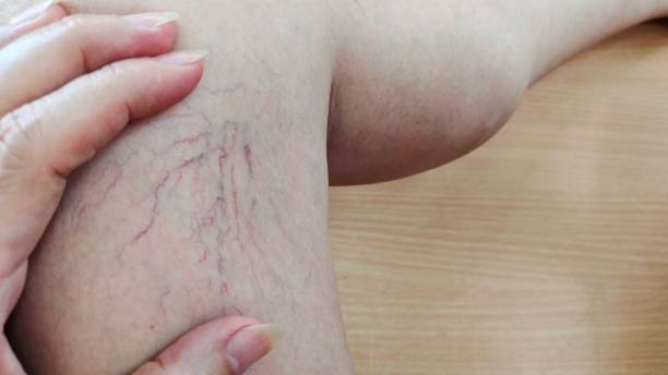 istock The varicose veins on the leg. 1490897624