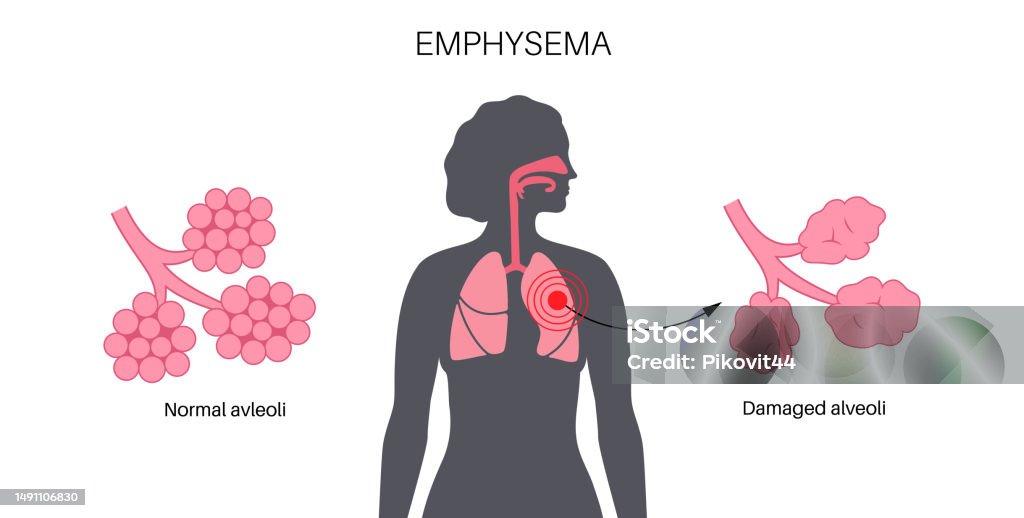 Empha Emphysema Anatomical Poster Stock Illustration - Download Image Now ...