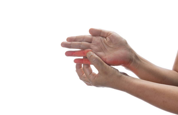 Numbness and tingling is a symptom of Ulnar tunnel syndrome, also known as Guyon's canal syndrome or Handlebar palsy, is caused by entrapment of the ulnar nerve in the Guyon canal as it passes through the wrist el entumecimiento y el hormigueo son un síntoma del síndrome del túnel cubital, también conocido como síndrome del canal de guyon o parálisis del manillar, es causado por el atrapamiento del nervio cubital en el canal de guyon a medida que pasa a tra