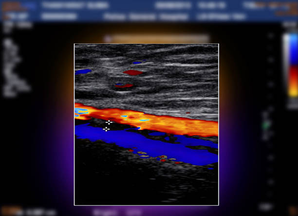 A carotid artery Doppler ultrasound is a diagnostic test used to check the arteries in the neck for diagnosis  any blockage in the veins by a blood clot or “thrombus” formation. stock photo
