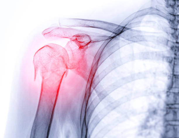 radiographie de l’articulation de l’épaule montrant une fracture de l’os de l’humérus. - x ray x ray image shoulder human arm photos et images de collection