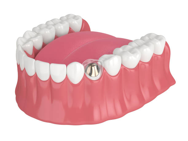 istock 3d render of lower jaw with cast post and core tooth restoration 1491199616
