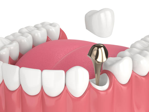 istock 3d render of lower jaw with cast post and core tooth restoration 1491199620