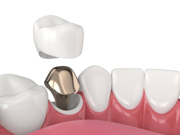 istock 3d render of lower jaw with cast post and core tooth restoration 1491199631