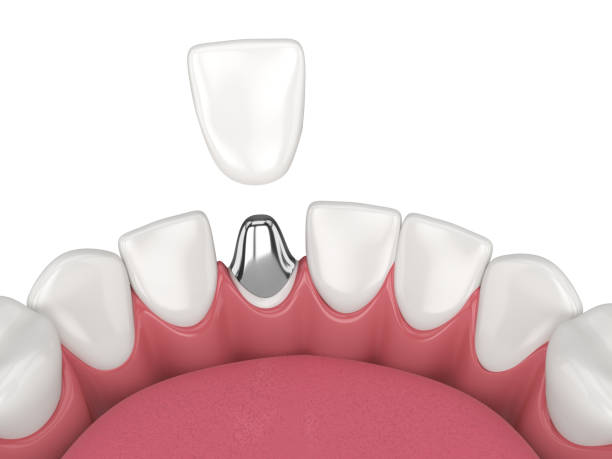 istock 3d render of lower jaw with cast post and core tooth restoration 1491216139