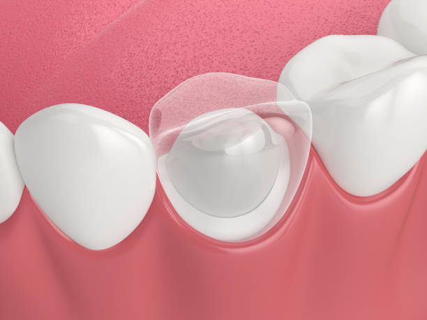 istock 3d render of lower jaw with dental post and core tooth restoration 1491216153