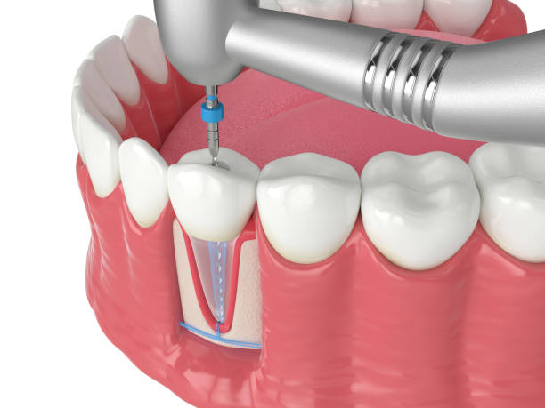 istock 3d render of lower jaw with handpiece and endodontic rotary file over white background 1491216163