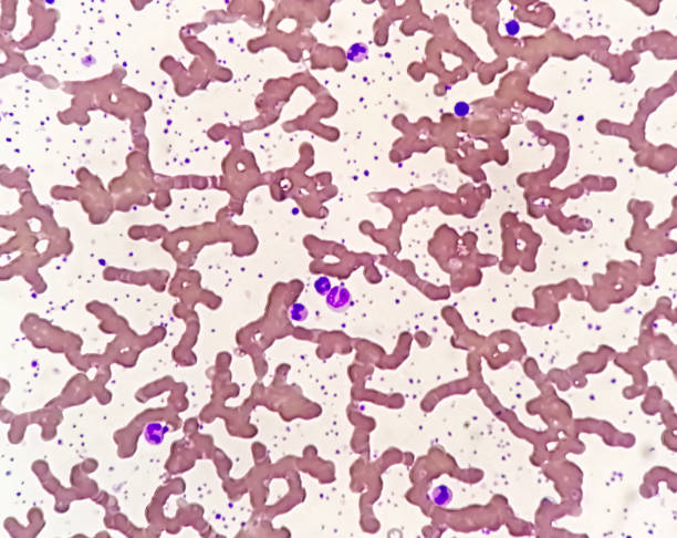 istock Thrombocytosis blood smear showing abnormal high volume of platelet analyze by microscope. Microscopic view of hematological stained slide. 1491224732
