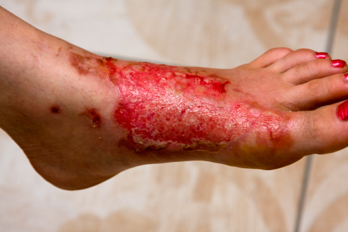 Severe burns in the women's leg .