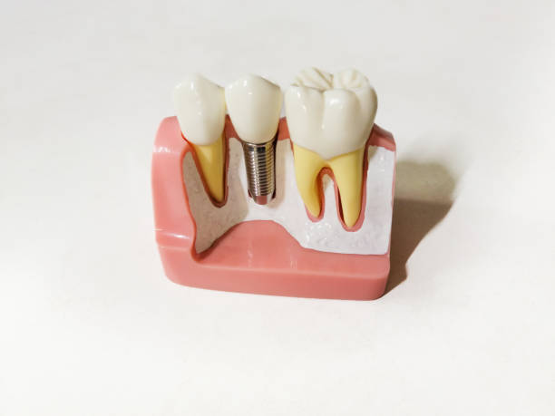 istock Dental caries and implant models 1491431708