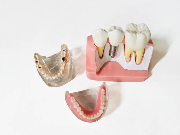 istock Dental caries and implant models 1491431716