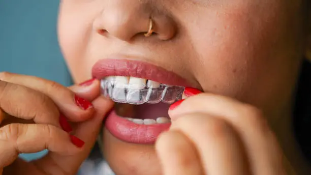 Photo of Young Asian Indian woman holding removable invisible aligner, also known as invisalign or  clear aligner