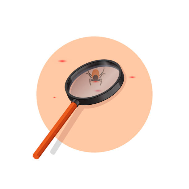 removing encephalitis ticks after bite. how to remove mite. parasite carrying disease.using magnifying glass to find ticks. - 蜱 動物 幅插畫檔、美工圖案、卡通及圖標