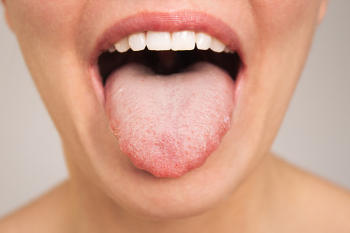 Caucasian woman opens her mouth and shows a sick tongue with teeth marks and a white plaque close-up. Endocrinology. Gastrointestinal diseases