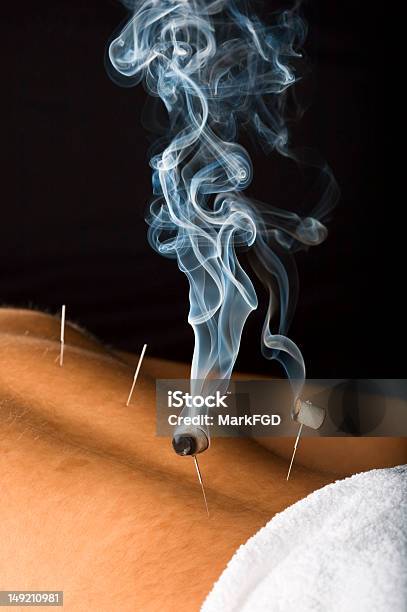 Burning Moxa On Male Patient Stock Photo - Download Image Now - Moxa, Acupuncture, Acupuncture Needle