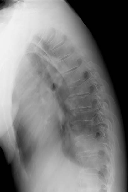 Thoracic Spine X-Ray stock photo