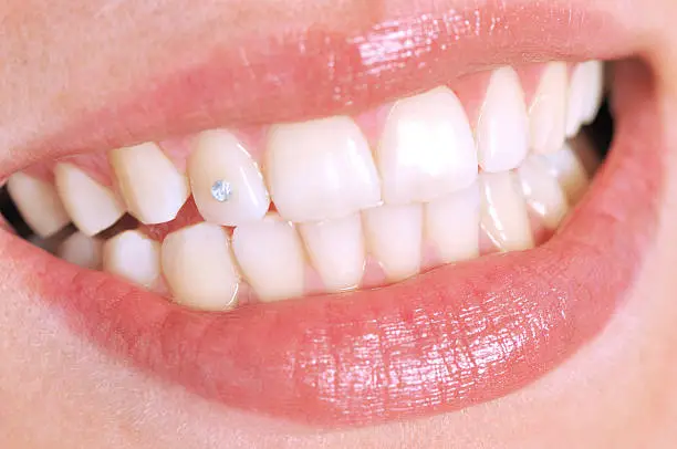 Close up of a smiling young woman's teeth with diamond - a series of DENTAL images.