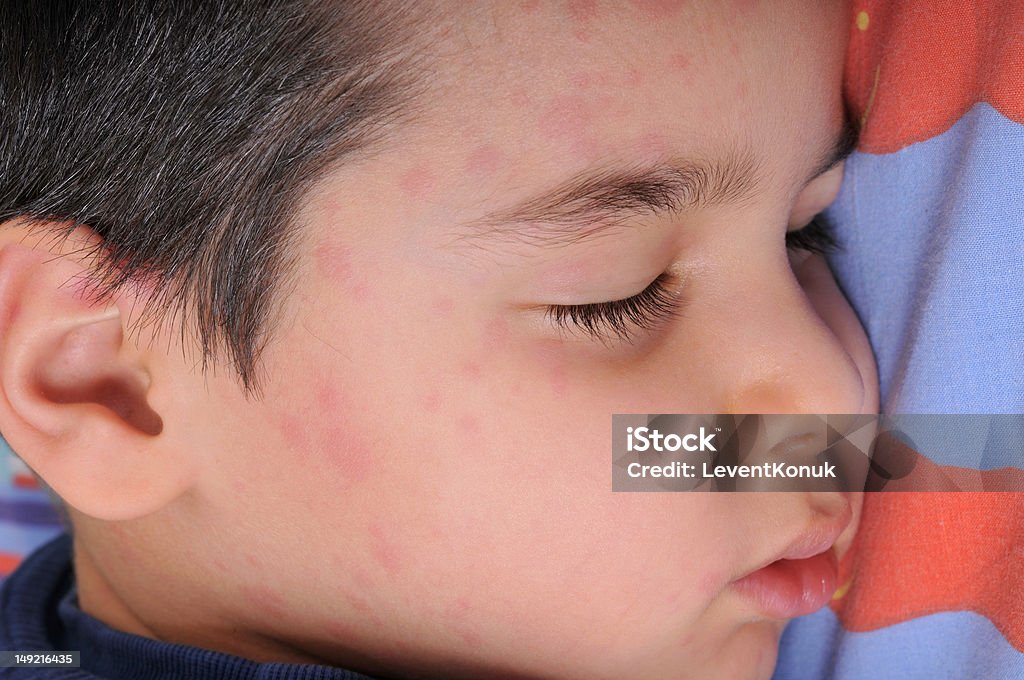 Uticarial Rash. Children Urticaria Stock Photo - Download Image Now - Mumps, Child, Hives - Skin ...