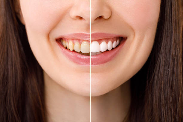 mujer sonriente antes y después del procedimiento de blanqueamiento dental, imagen de primer plano. - blanqueamiento dental fotografías e imágenes de stock
