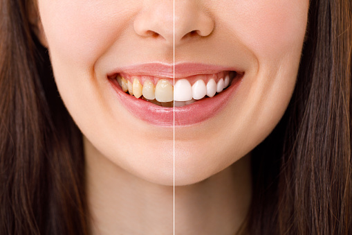 Smiling woman before and after the teeth whitening procedure, close-up image