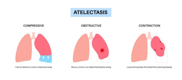 Vector illustration of Atelectasis medical poster