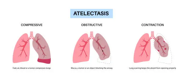 Vector illustration of Atelectasis medical poster