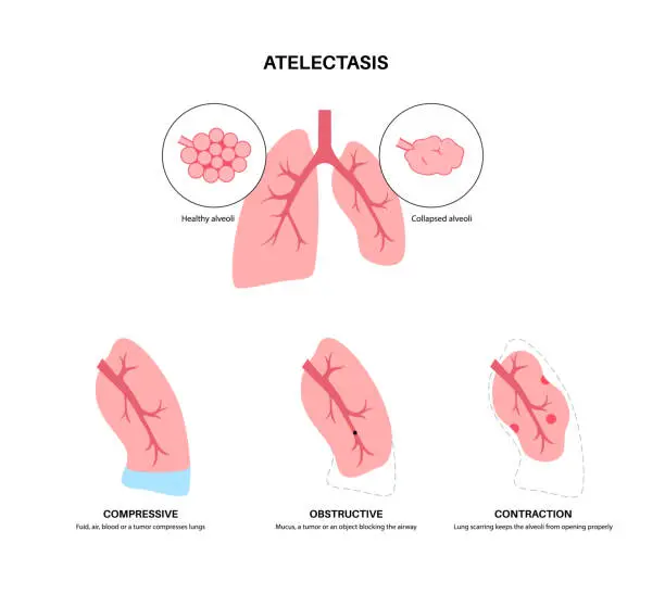 Vector illustration of Atelectasis medical poster