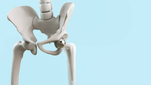Hip replacement Xray of Hip Replacement,Medicine, medical and healthcare, surgery, science concepts. hip replacement stock pictures, royalty-free photos & images