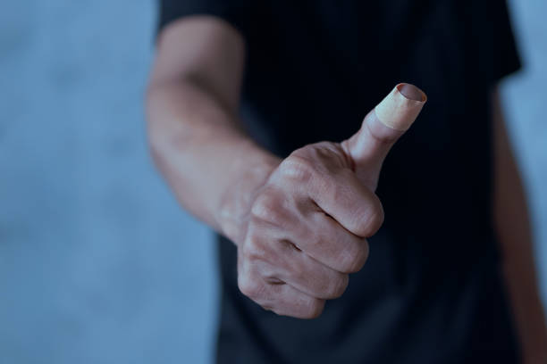 istock Man placing bandage or adhesive plaster on his thumb finger. plaster on the wound 1492645110