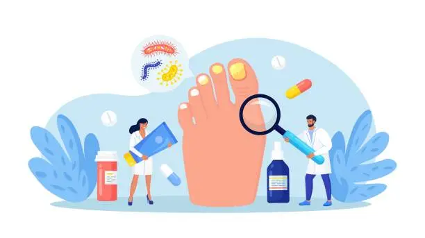 Vector illustration of Onychomycosis. Nail disease, fungal nails infection. Doctors exam and treat nails psoriasis. Doctor dermatologist analyzes psoriatic toenails. Paronychia. Inflammation of the skin around toenail